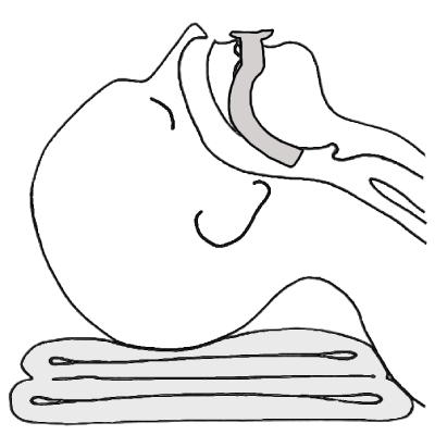 Via a&eacute;rea orofar&iacute;ngea